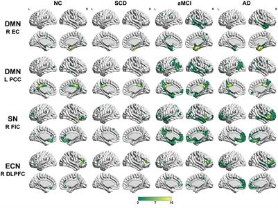 Divergent Connectivity Changes in Gray Matter Structural Covariance Networks in Subjective Cognitive Decline, Amnestic Mild Cognitive Impairment, and Alzheimer’s Disease